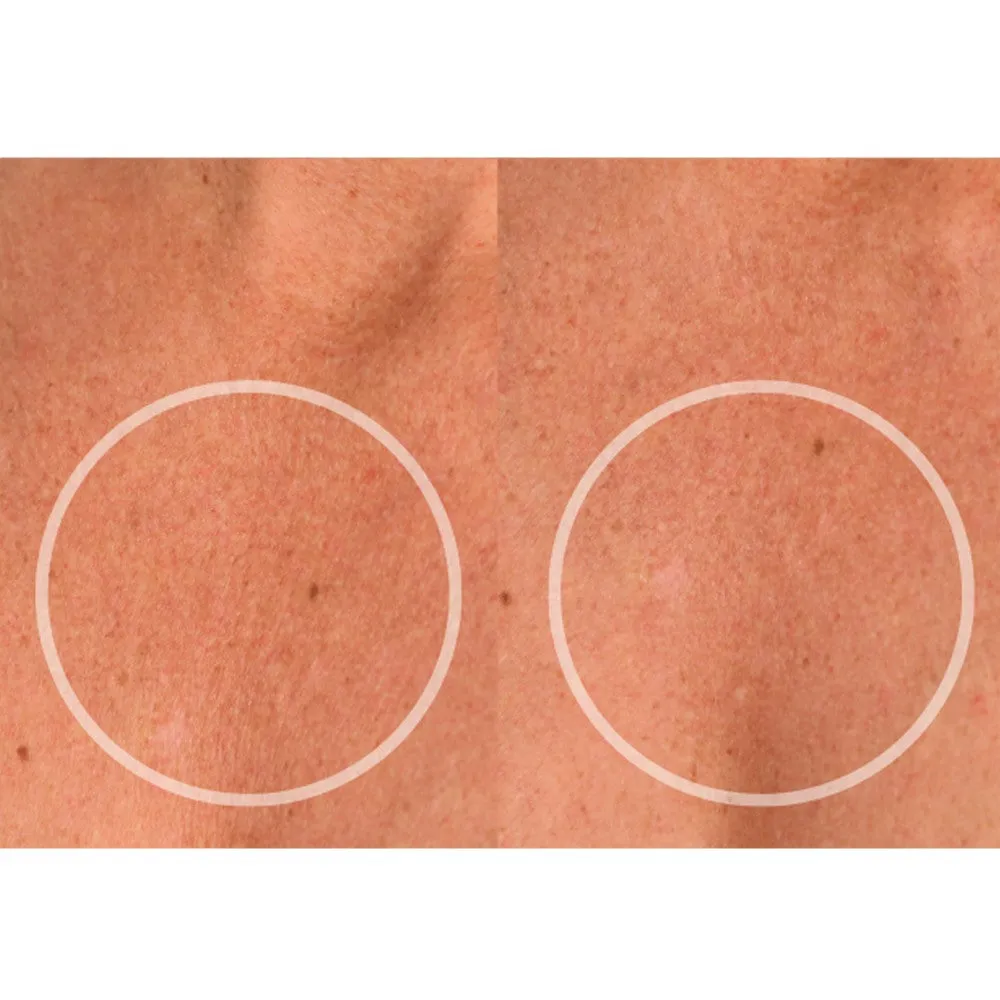 ChestLift (2 Pack)